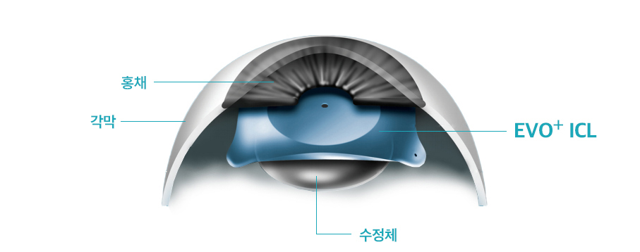 아쿠아렌즈삽입술